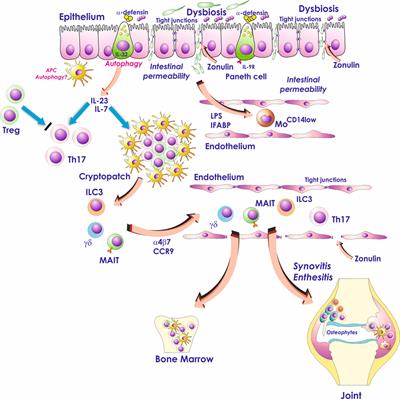 Role of Subclinical Gut Inflammation in the Pathogenesis of Spondyloarthritis